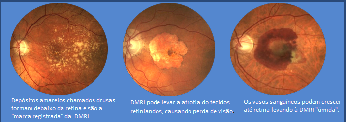 Retina: 3 doenças hereditárias e raras. - CBCO