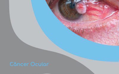 Você sabia que também existe câncer ocular?